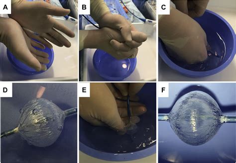 Effect of air removal with extracorporeal balloon inflation on ...