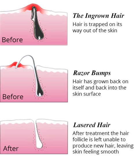 Ingrown Hair Pictures, Best Ingrown Hair Treatment Laser Hair Removal, If you visit your ...