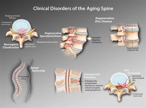 degenerative disc disease | HealthPlexus.net