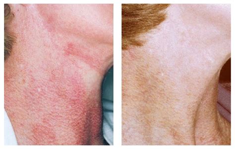 Poikiloderma of Civatte (Neck Pigmentation) - DermaCare Cosmetic and ...