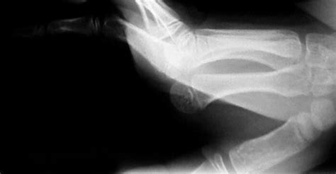 MCP Dislocations - Hand - Orthobullets