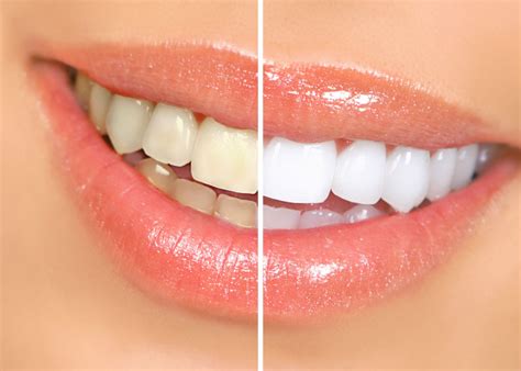 3 Teeth Whitening Procedures That Work