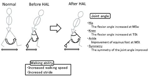 Gait pattern. The improvements in equinus gait and flexion angle of the... | Download Scientific ...