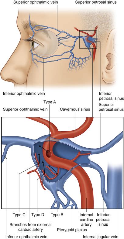 Vascular Fistulae and Orbital Implications | Ento Key