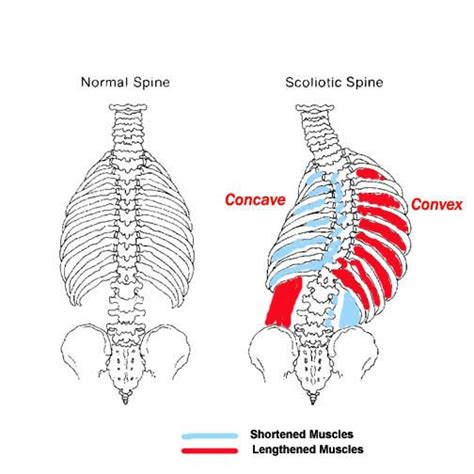 Degenerative Scoliosis - Non-Surgical Treatment - CSC