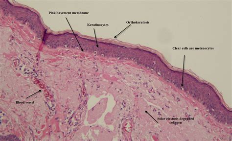 Dermpath Made Simple - Neoplastic: Introduction to skin histopathology