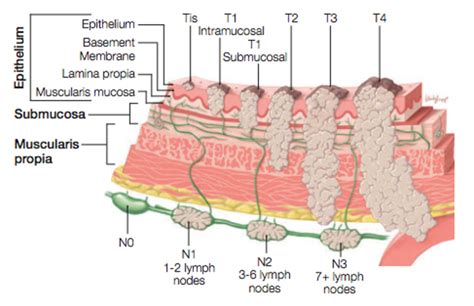 Understanding Barrett's Esophagus - University Hospitals