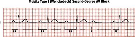 Second degree atrioventricular block - ECG / Mobitz type I, type II ...