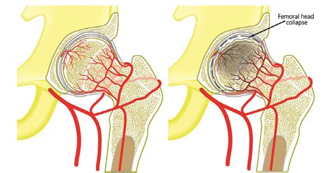 Avascular Necrosis Symptoms Causes Diagnosis Treatment Prevention | SexiezPicz Web Porn