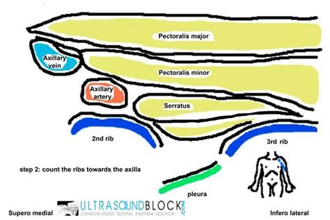 Ultrasound: Thoracic wall (PECS) blocks