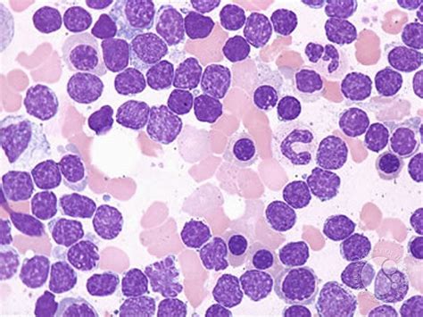 Chronic Lymphocytic Leukemia - 3.