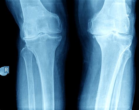 Xrays vs. MRI: Do I really need an xray? | Dr. David Geier - Sports Medicine Simplified