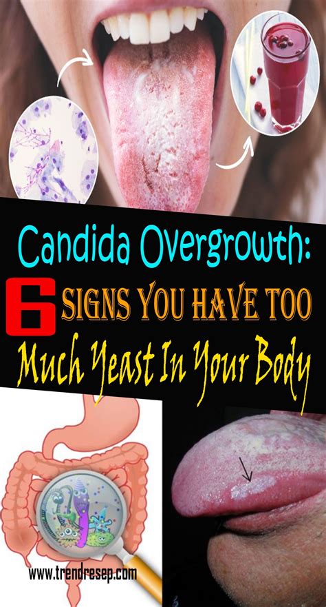 Candida Overgrowth: 6 Signs You Have Too Much Yeast In Your Body - articleremedies35