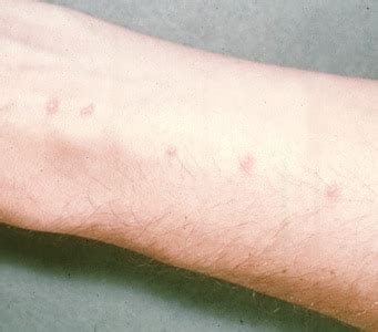 CDC - DPDx - Cercarial Dermatitis