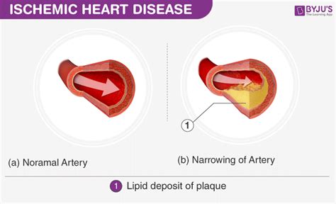 Heart Diseases - Types of Heart Diseases, Causes and Treatments