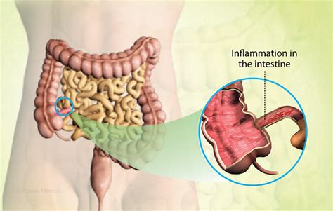 Health Condition : Symptoms, Causes, Treatment and More