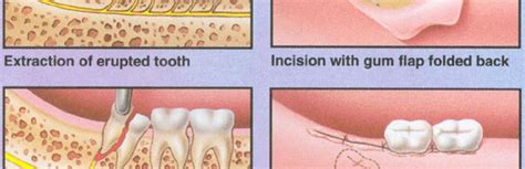 Cost of Wisdom Tooth Removal Extraction | Thornhill Dentist North York ...