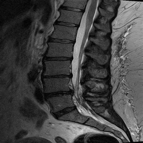 Neurogenic Claudication Symptoms – Study Spine A to Z