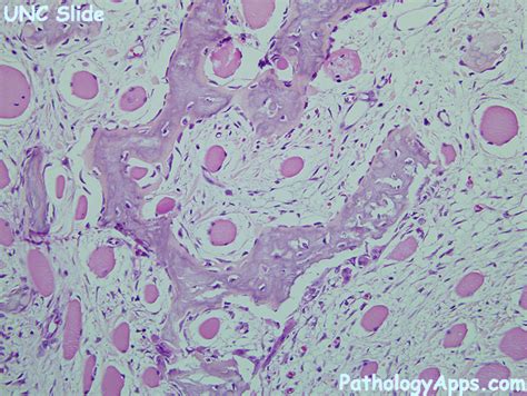 myositis ossificans pathology