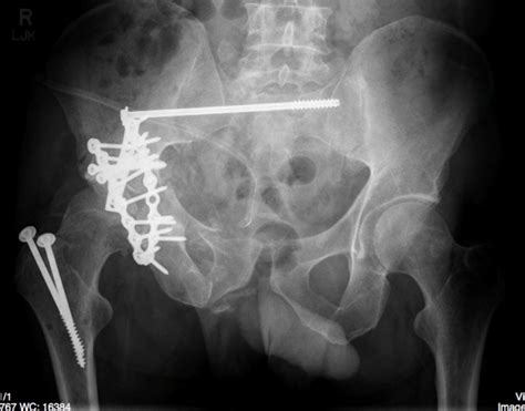 Pelvic Fracture – Undergraduate Diagnostic Imaging Fundamentals