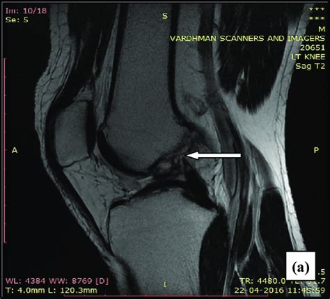 Mri Knee Acl Tear