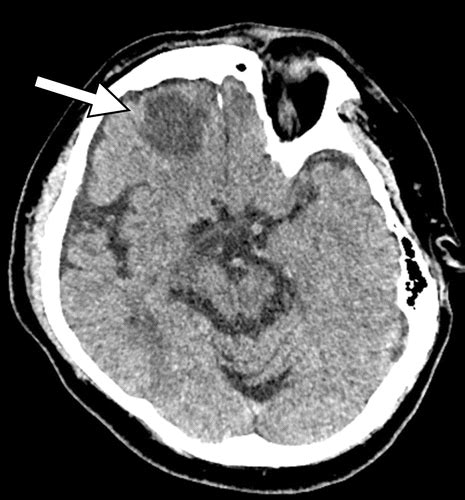 Traumatic Brain Injury: Imaging Patterns and Complications | RadioGraphics