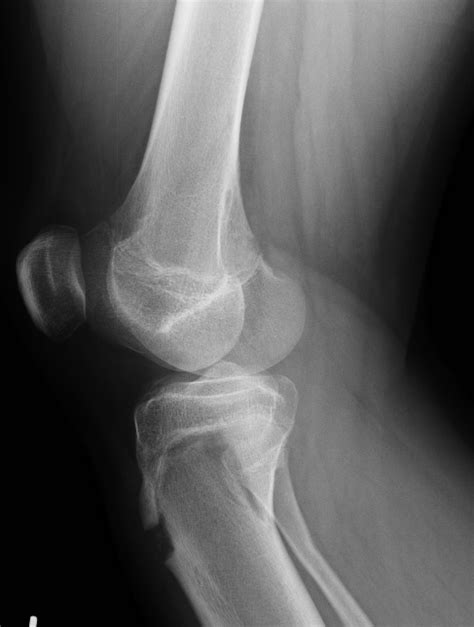 Tibial Tuberosity Fracture