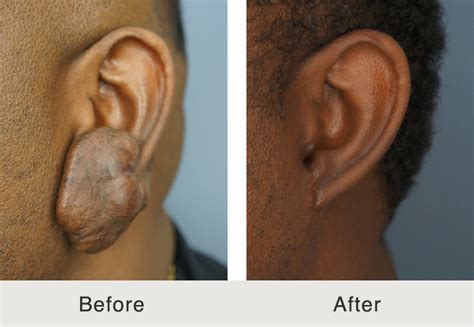 Keloid Scar Removal - Carolina Facial Plastics