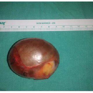 Postoperative view of an ovarian dermoid cyst. | Download Scientific Diagram