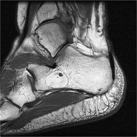 Intraosseous lipoma | The Foot and Ankle Online Journal