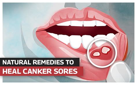 How To Fight Canker Sores - Shopfear0