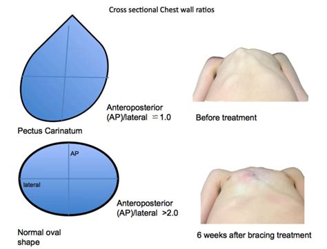 Pectus carinatum causes, symptoms and treatment | Braceworks Custom Orthotics