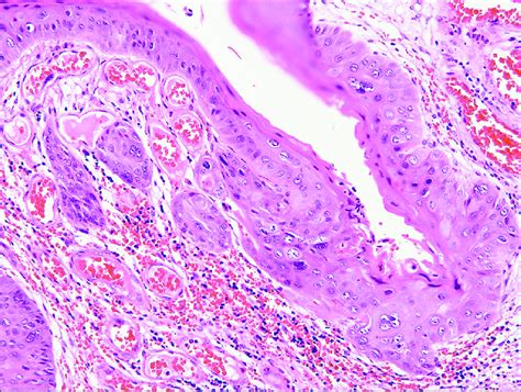 The squamous epithelium of the urethral caruncle was partially ...