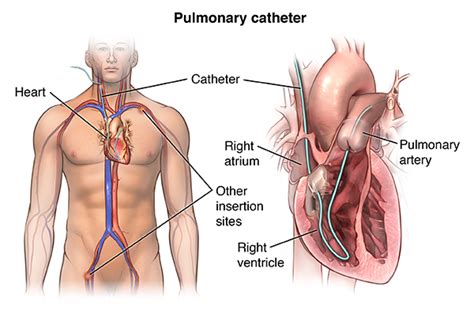 Right Heart Catheterization | Johns Hopkins Medicine Health Library