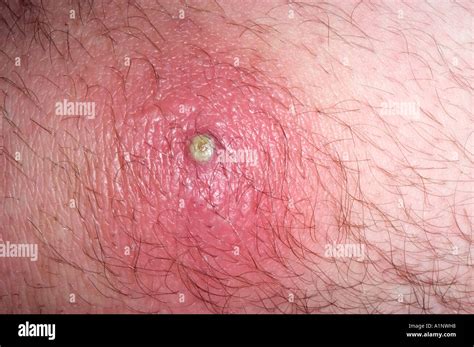 methicillin resistant staph aureus skin infection in a 26 year old male ...