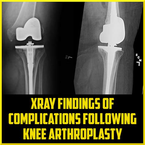 Imaging After a Complete Knee Arthroplasty - foppa.casa