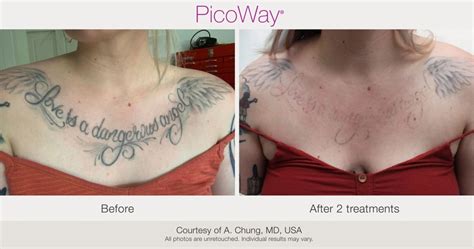 PicoWay Laser Tattoo Removal – Synergy Medical Aesthetics – Nanaimo, Victoria, Vancouver Island