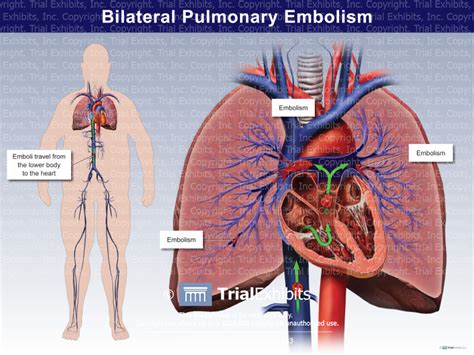 Bilateral Pulmonary Embolism - Trial Exhibits Inc.