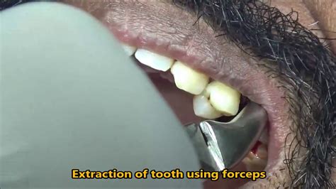 Fractured & Failed root canal treated upper 2nd premolar extraction - YouTube