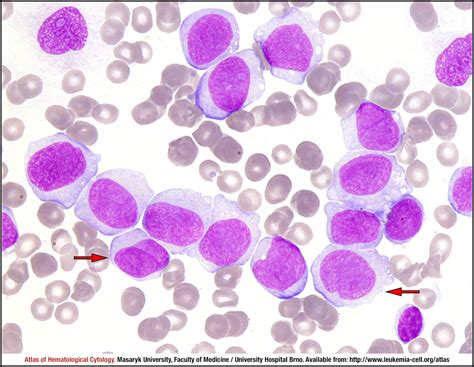 Acute Myelomonocytic Leukemia