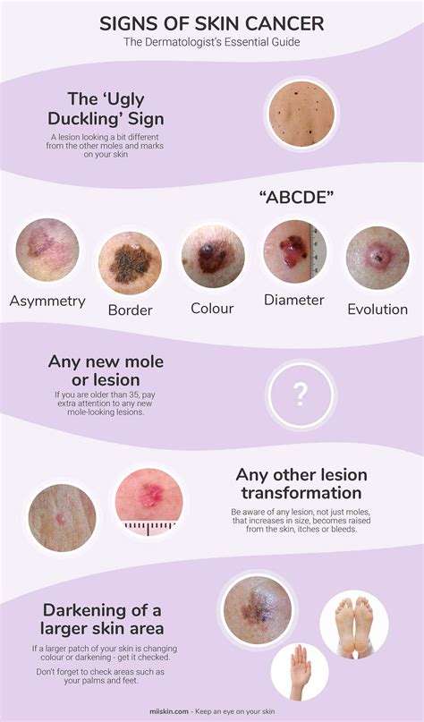 Examples Of Skin Cancer Types