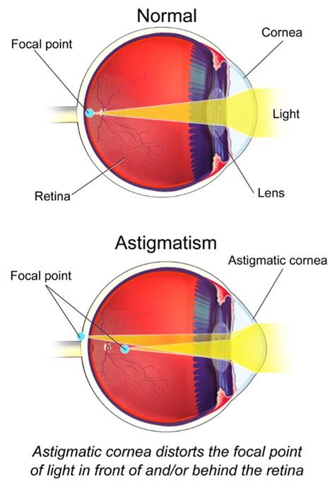 Can laser eye surgery fix astigmatism?