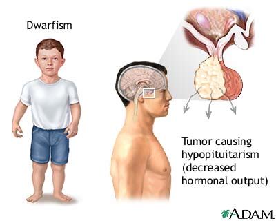 Dwarfism, pituitary. Causes, symptoms, treatment Dwarfism, pituitary