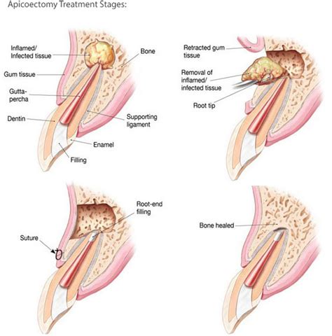 Apicoectomy – PerioClinik Dr. Freddy Fokam