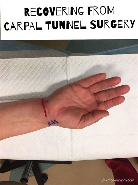 Carpal Tunnel Surgery Recovery: 3 Months Later | Carpal tunnel surgery, Carpal tunnel surgery ...