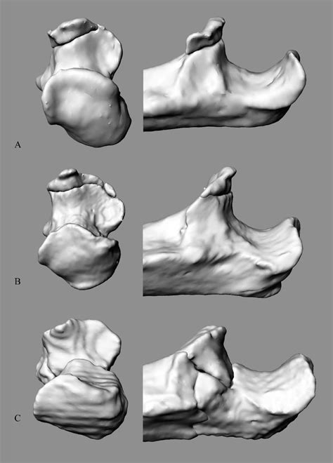 Involvement of the lesser sigmoid notch in elbow fracture dislocations - Journal of Shoulder and ...