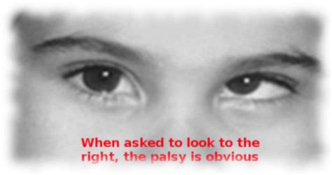 [Figure, Trochlear nerve palsy Image courtesy S Bhimji MD] - StatPearls - NCBI Bookshelf