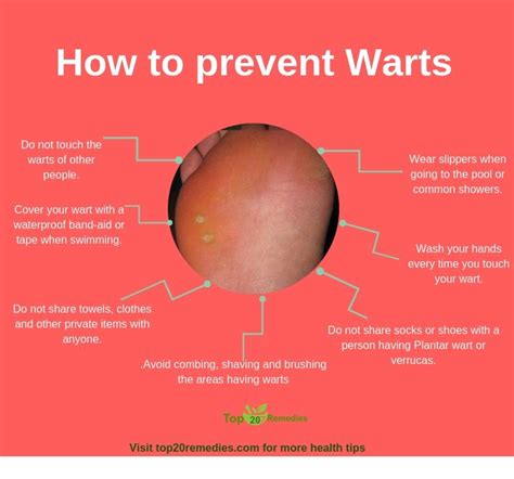 How to get rid of genital warts fast home remedies | Home remedies, Remedies, Health problems