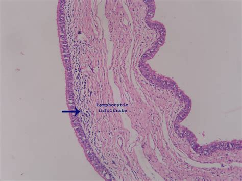 Branchial cleft cyst – Histopathology.guru