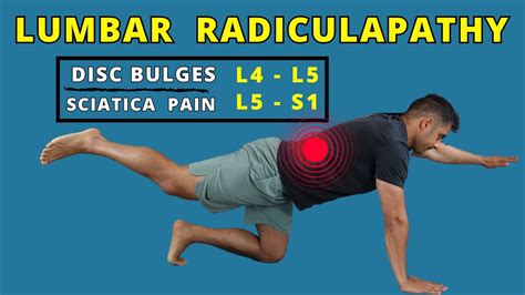 Lumbar Radiculopathy L4 L5 - L5 S1 exercises for pain relief - YouTube